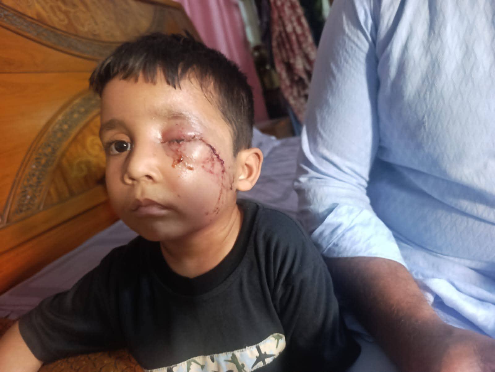 Child Injured in Dog Attack Dies in Kharian